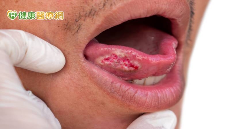 他舌部潰瘍罹口腔癌第三期 竟是「3提神食物」釀禍