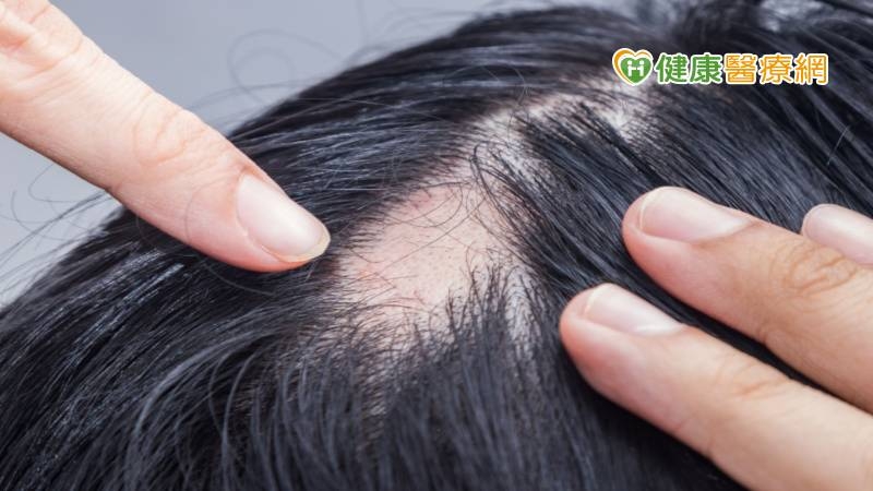 輕熟女竟「禿了」！自信全無陷焦慮　醫揭病因