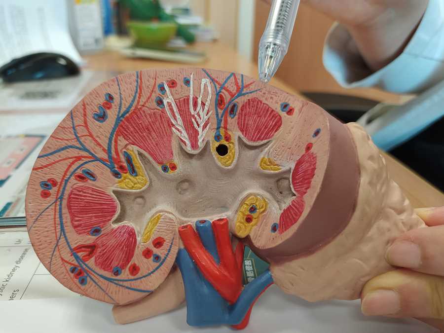 婦人經腎臟切片檢查,確認罹患紅斑性狼瘡性腎炎。