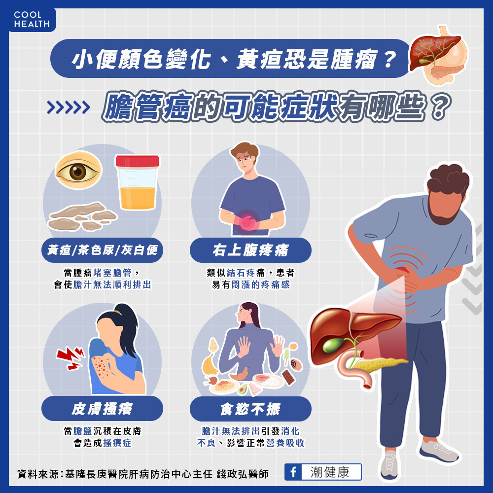 小便顏色變化、黃疸恐是腫瘤? 膽管癌的可能症狀 小便顏色變化、黃疸恐是腫瘤? 膽管癌的可能症狀