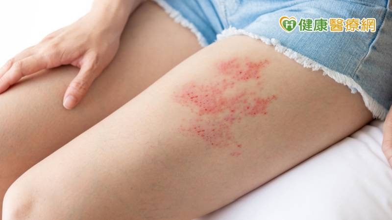 皮蛇好發高峰期!醫警告「1情況」就可能發病 預防方式看這
