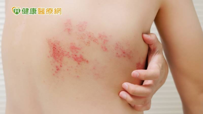 小心帶狀疱疹爬上身 施打帶狀疱疹疫苗來預防