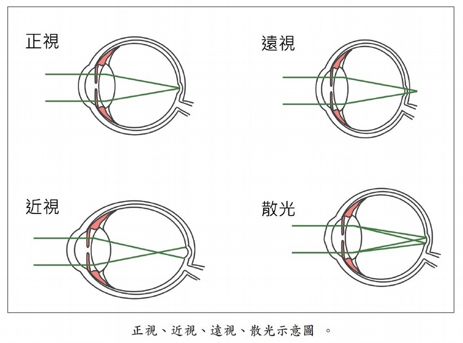 弱視、遠視、散光的差別?