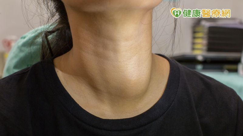 甲狀腺結節手術怕留疤?達文西手術開啟「頸部無痕」新世界