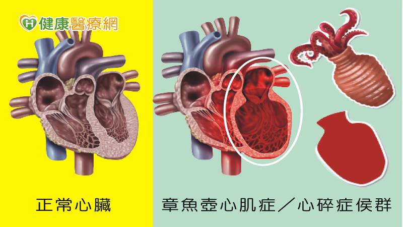患者左心室呈現章魚弧形狀,疑似「章魚壺心肌症」或稱「心碎症侯群」。