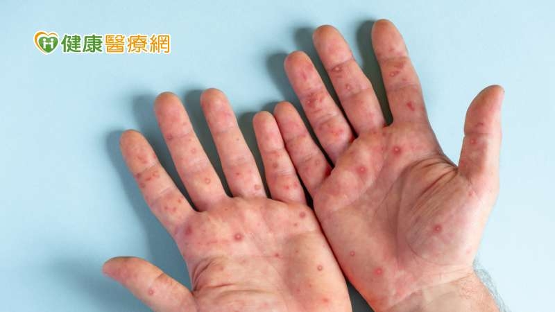 首例兒童猴痘!4歲童因家人接觸感染 疾管署提醒「這些」都是傳染途徑
