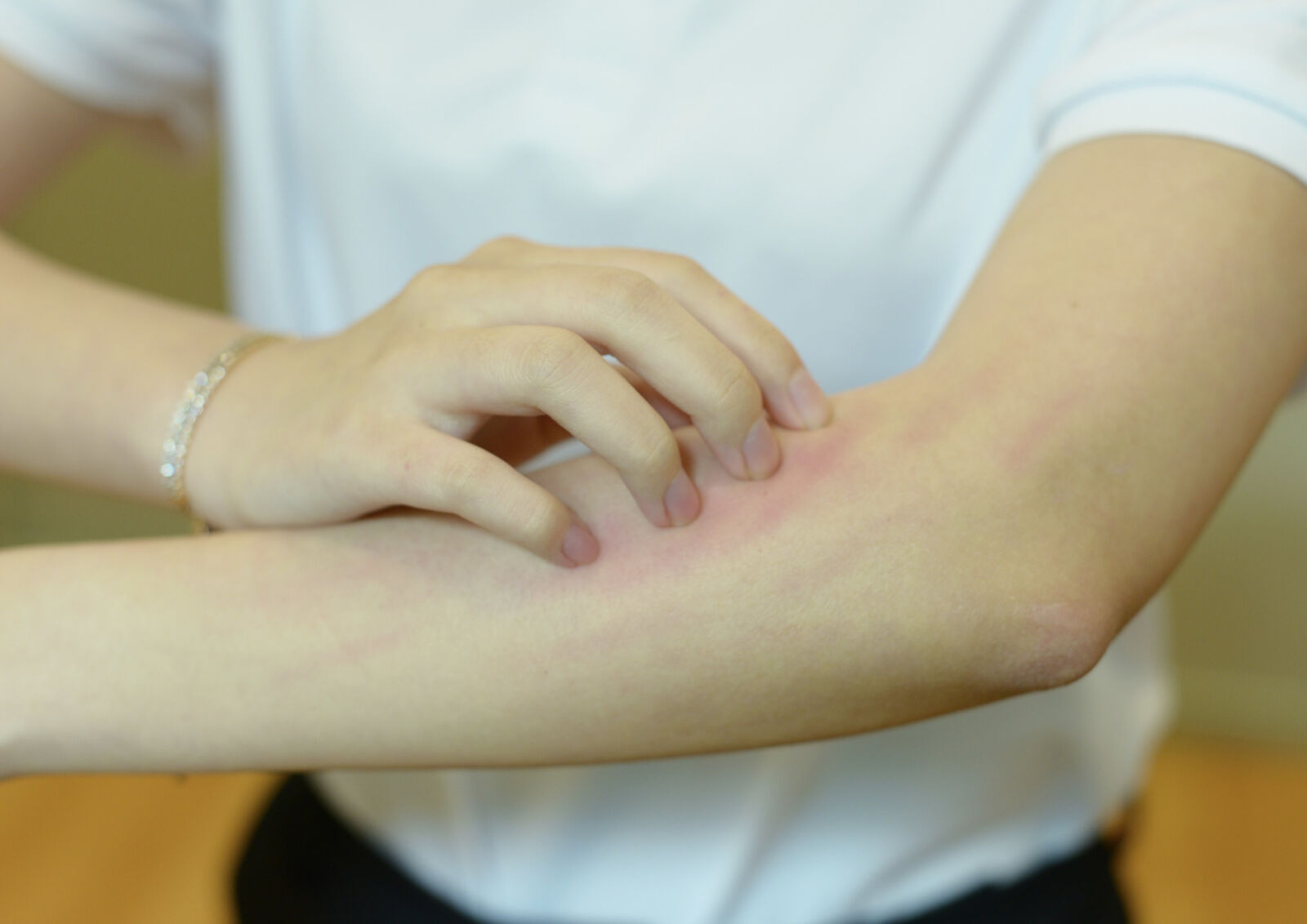 過了「芒種」溼疹季節報到! 紅、腫、熱、痛、癢得懂對症下藥 312 過了「芒種」溼疹季節報到! 紅、腫、熱、痛、癢得懂對症下藥 311