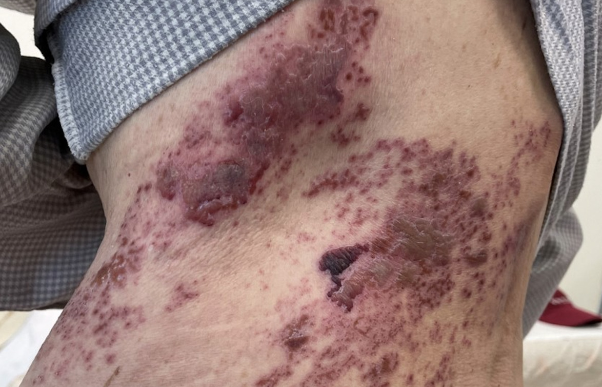 糖尿病罹「皮蛇」機率高2倍 北榮研究:66年老藥有奇效「預防兼減痛」! 292 糖尿病罹「皮蛇」機率高2倍 北榮研究:66年老藥有奇效「預防兼減痛」! 291