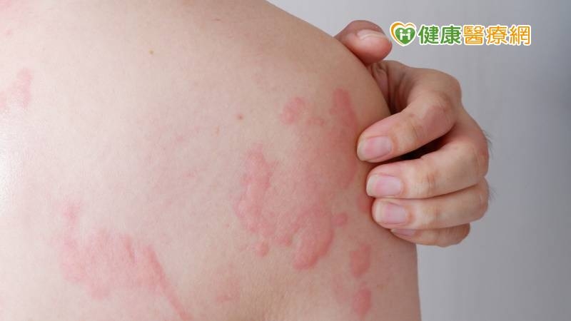 男子服感冒藥全身搔癢、冒皮疹 醫揭「1原因」惹禍:還可能致命
