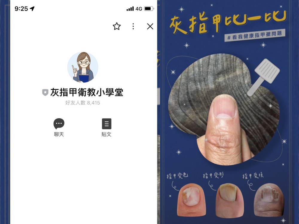 悶熱夏天小心灰指甲找上門！手機濾鏡拍照輕鬆比對確認 307