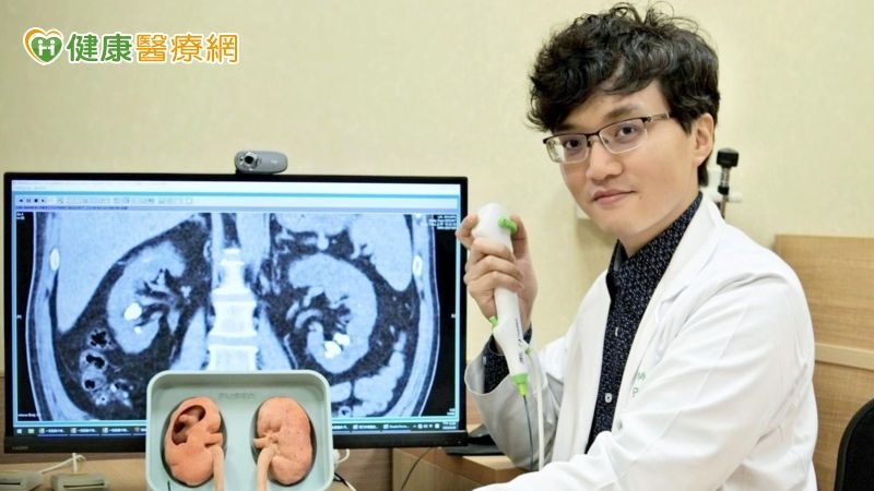 腎結石化作滿天星斗,「新型軟式輸尿管鏡手術」無刀口擊碎取出