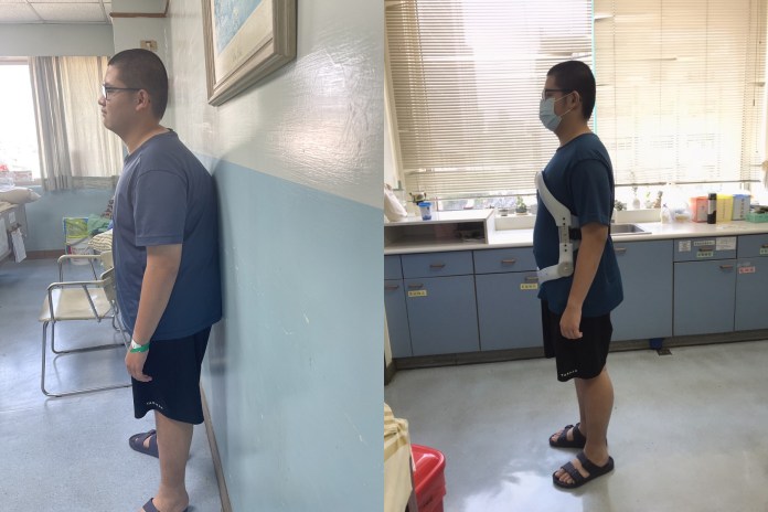 脊椎駝背又側彎 矯正手術讓高中生抬頭挺胸 80 P01 | 健康 記者爆料網