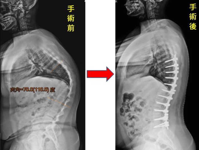 脊椎駝背又側彎 矯正手術讓高中生抬頭挺胸 77 70度的駝背 | 健康 記者爆料網