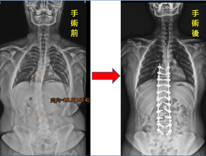 脊椎駝背又側彎 矯正手術讓高中生抬頭挺胸 78 26度的脊椎側彎 | 健康 記者爆料網