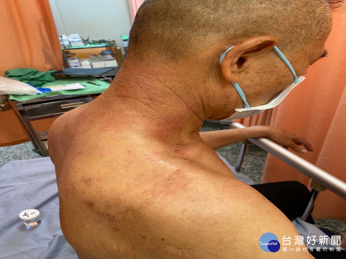 男子用精油按摩舒壓二度灼傷 醫師呼籲:使用精油記得稀釋避免受傷