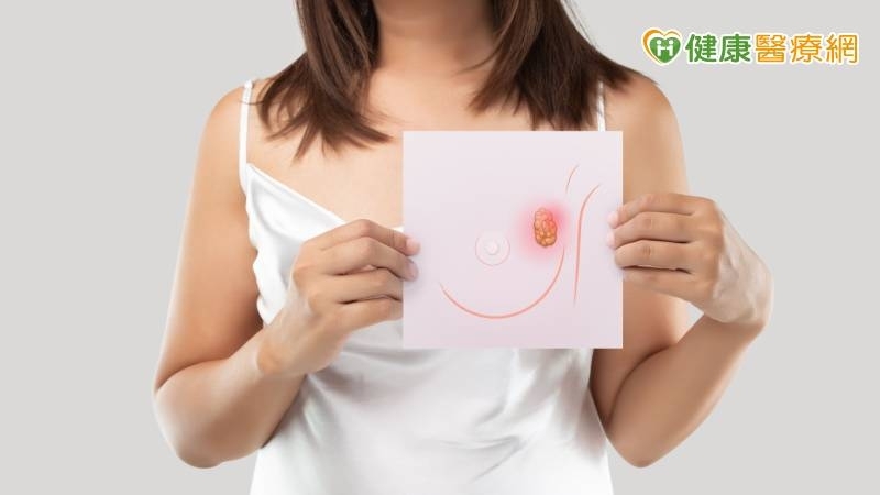 乳房出血還散發惡臭,一檢竟末期「三陰性乳癌」 免疫治療延緩惡化