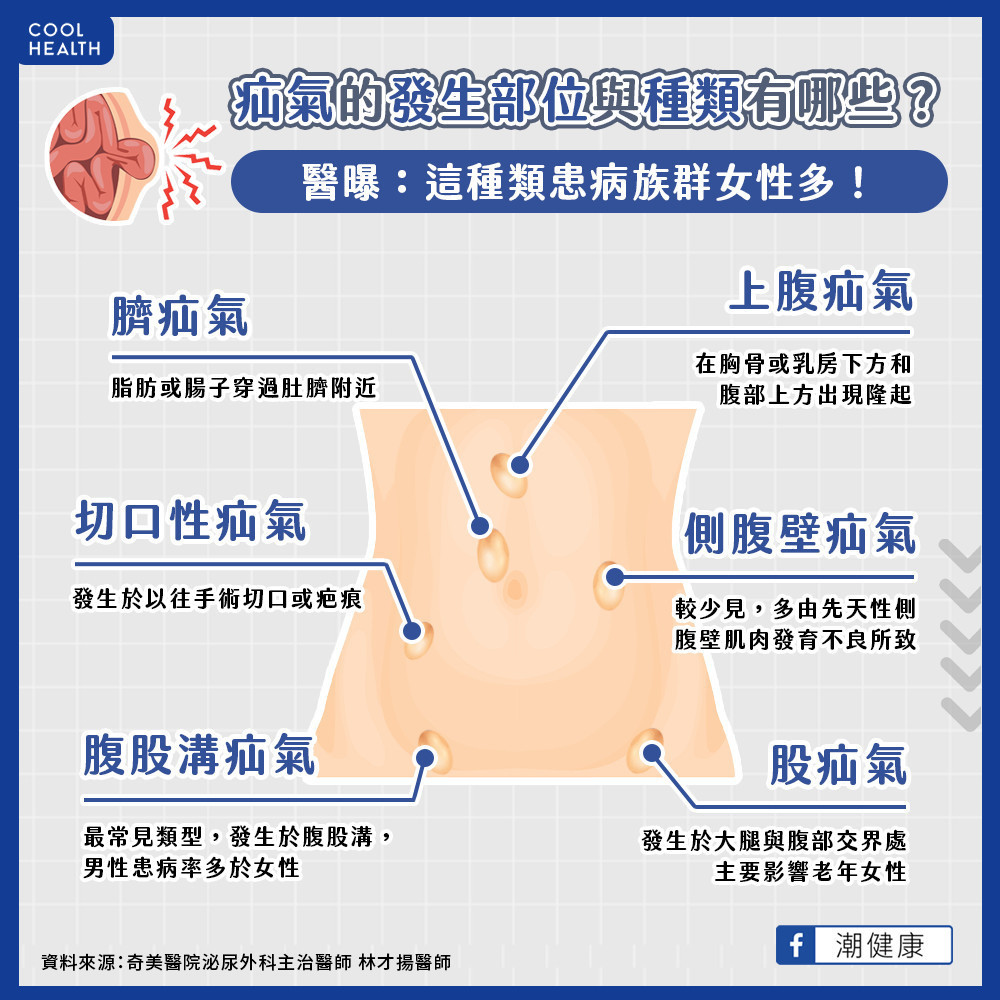 她下面突「一大包」急救醫 發現竟是「腹股溝疝氣」惹禍 她下面突「一大包」急救醫 發現竟是「腹股溝疝氣」惹禍