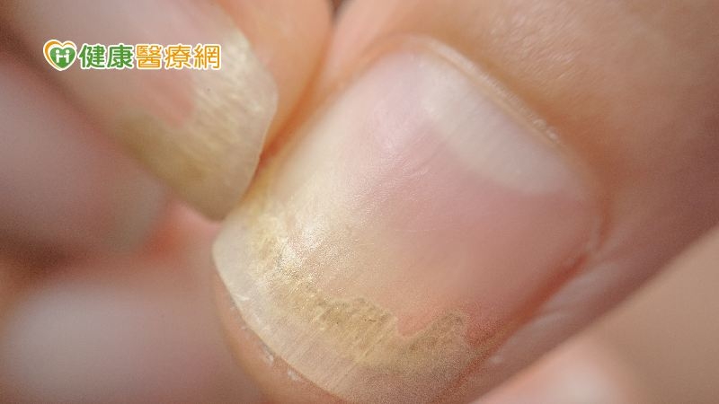 指甲變色、變厚、變形不一定是灰指甲! 「這些」都可能產生指甲症狀