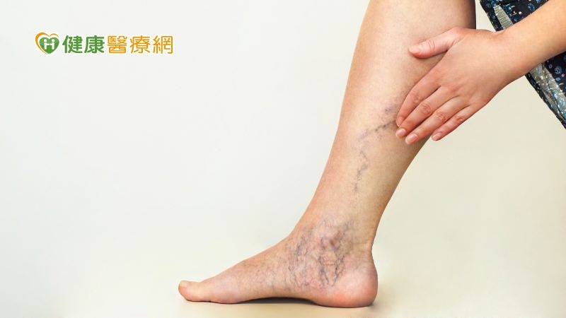 「這些人」易有靜脈曲張　如何預防、緩解症狀？醫師傳授抬腳、按摩方法