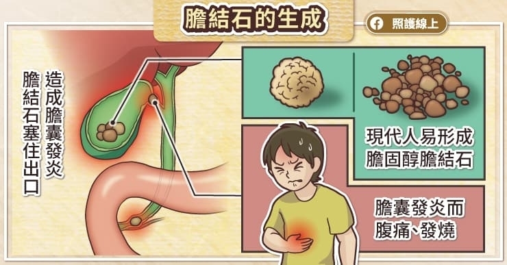 膽結石是什麼?
