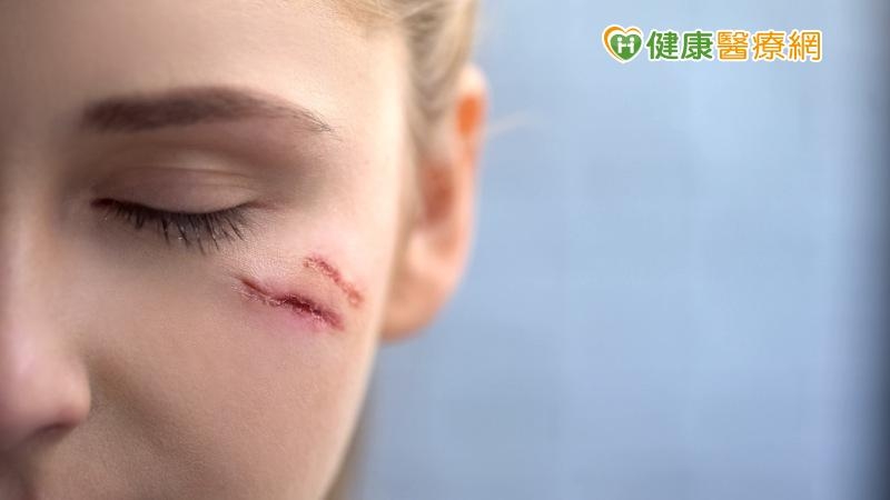 改善破相疤痕 拿回你的人生主導權