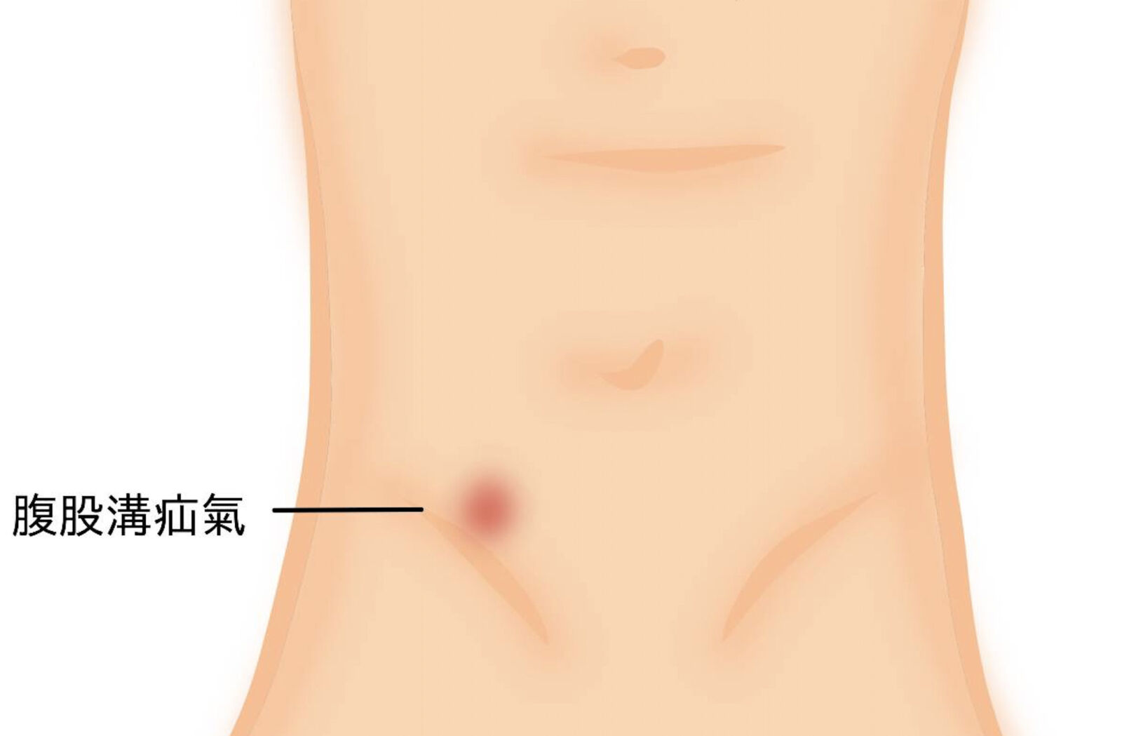 下腹部又痠又脹... 竟是腸子掉進腹股溝!三因素恐害一再復發 218 下腹部又痠又脹... 竟是腸子掉進腹股溝!三因素恐害一再復發 217