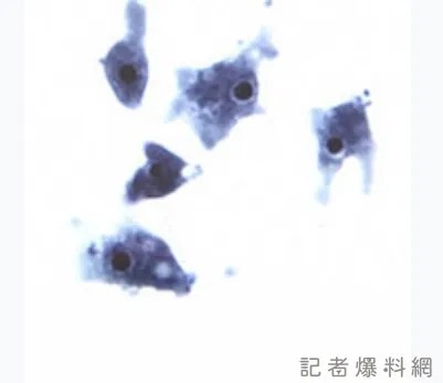 新北女性感染「食腦變形蟲」死亡 親水設施檢驗出爐12件檢體全部陰性 71 食腦變形蟲