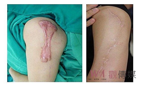 「蟹足腫」困擾近20年 專業醫療有解方 患者喜悅美好人生