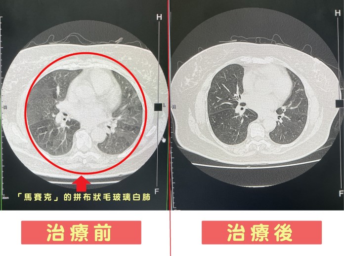 吸入鴿糞險變菜瓜布肺 7旬婦人呼吸困難罹過敏性肺炎 78 治療前後2 工作區域 1 | 健康 記者爆料網