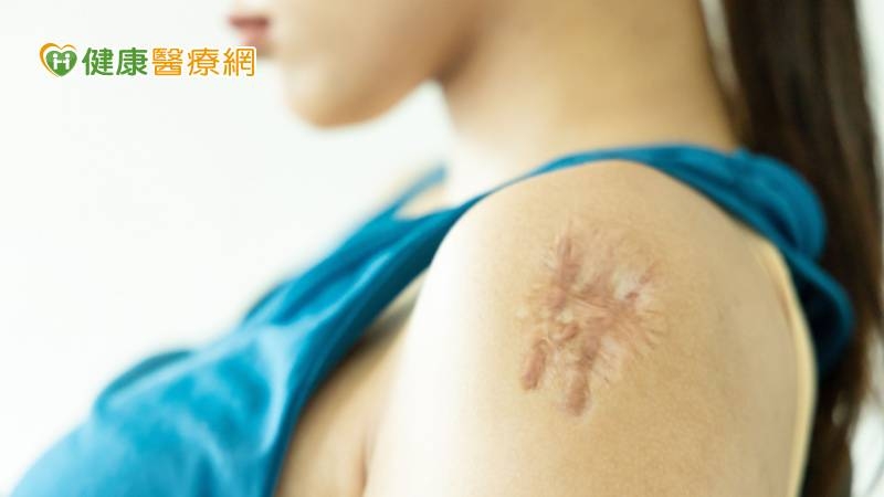 手臂「蟹足腫」困擾20年 「1治療」方式解決心頭大患