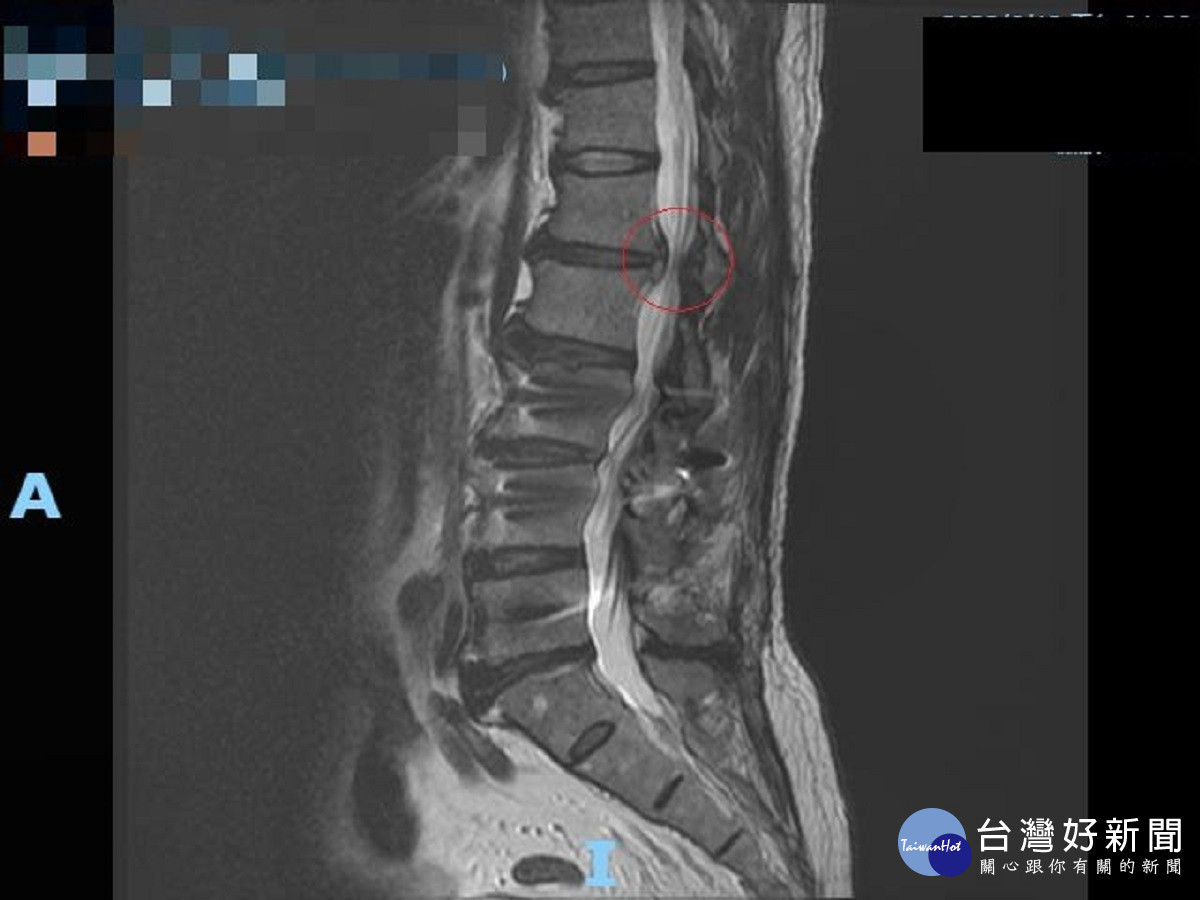 男腹股溝疼痛疑是結石引發 檢查病灶卻是近胸椎的椎間盤突出引發