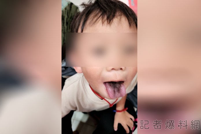 4歲男童口服10天抗生素 口腔赫見「黑毛舌」嚇壞媽媽 80 1 5 | 健康 記者爆料網