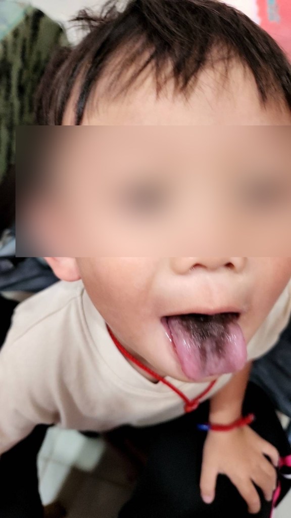 4歲男童口服10天抗生素 口腔赫見「黑毛舌」嚇壞媽媽 76 | 健康 記者爆料網