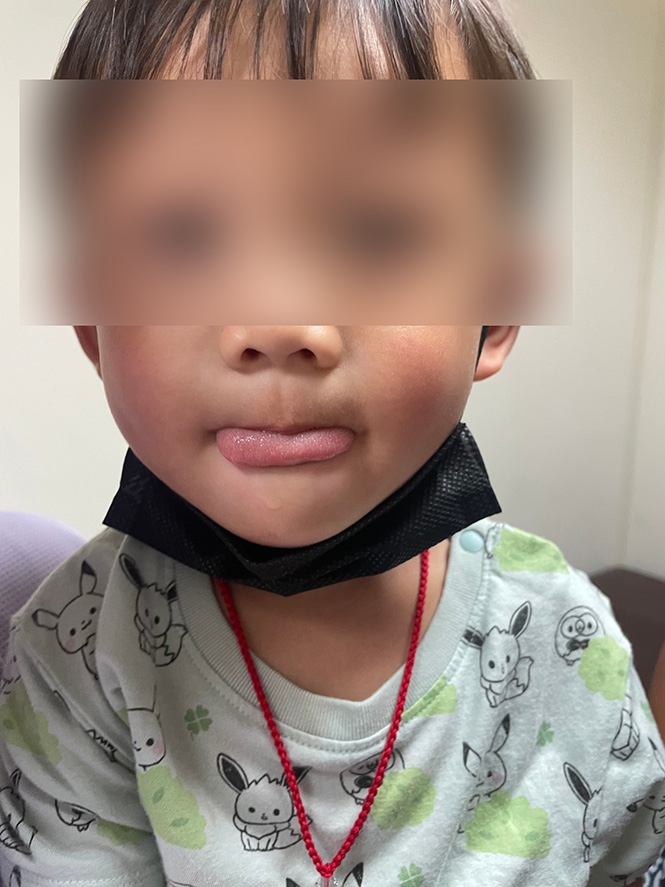 4歲男童口服10天抗生素 口腔赫見「黑毛舌」嚇壞媽媽 77 | 健康 記者爆料網