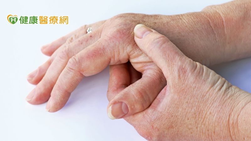 乾癬性關節炎纏身10年! 生物製劑解除疼痛警報 