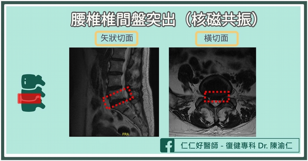 單車運動傷害2:脊椎