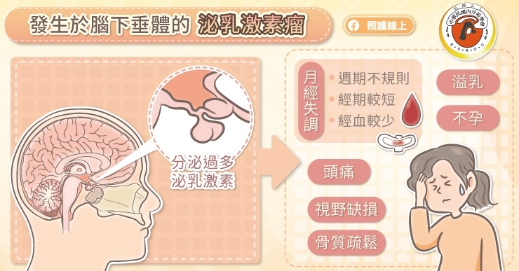 泌乳激素瘤常見症狀有哪些?