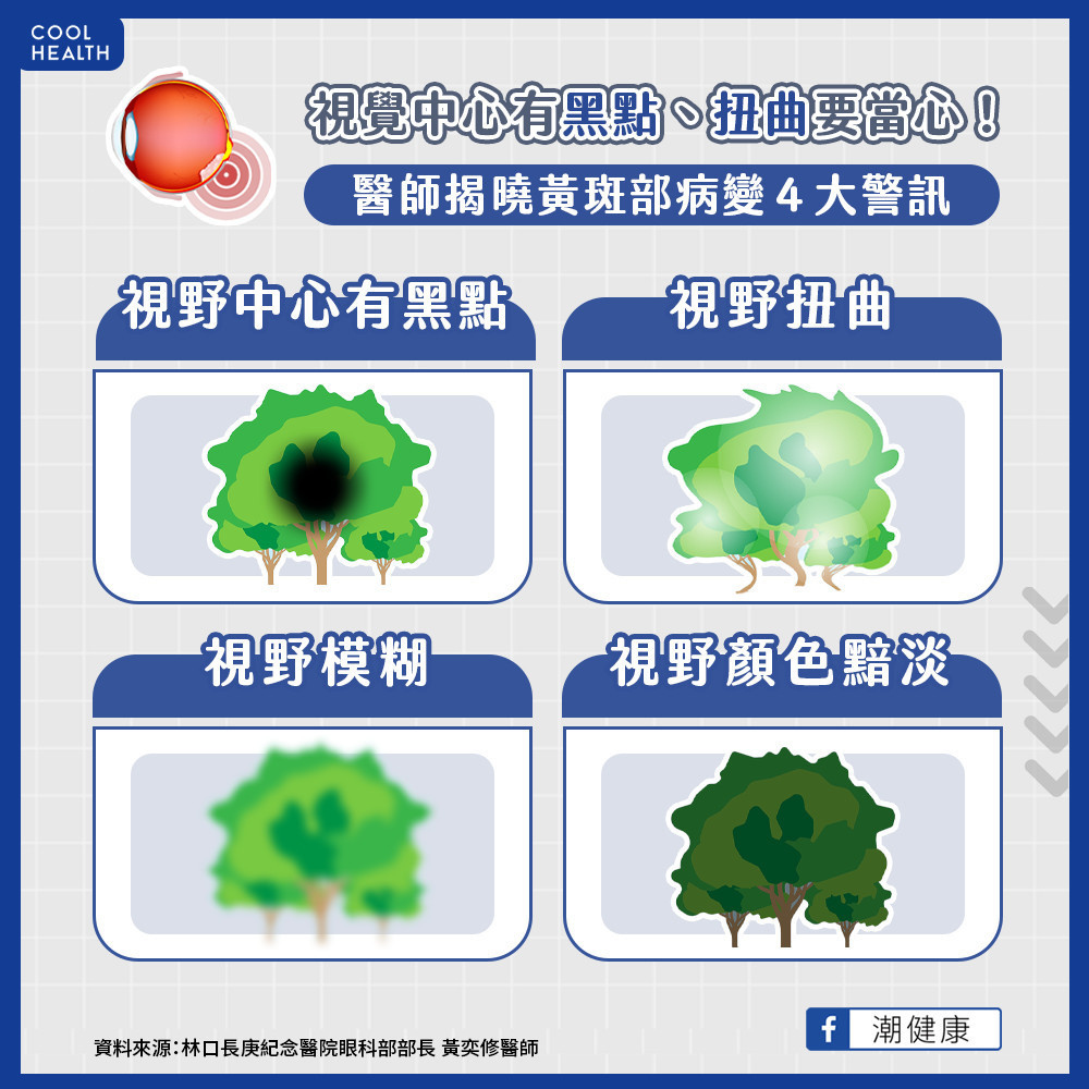視覺中心有黑點、扭曲要當心！  黃斑部病變四大警訊