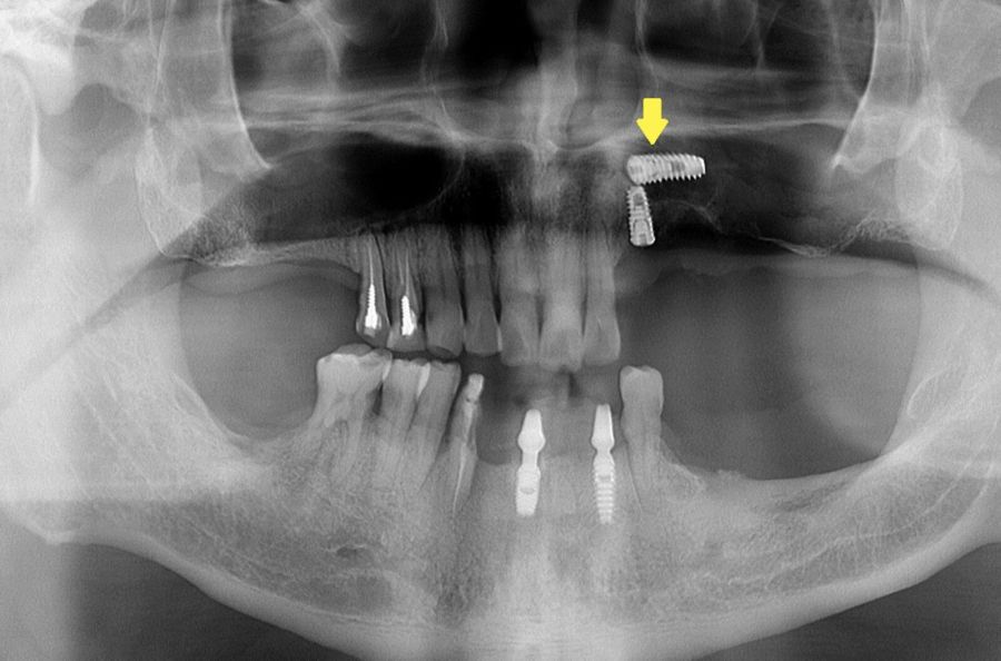 缺牙男花錢植牙卻「發燒又臉腫」! 竟是人工牙根掉入鼻竇 234 缺牙男花錢植牙卻「發燒又臉腫」! 竟是人工牙根掉入鼻竇 233