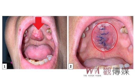 口腔不明硬塊影響進食 手術治療重拾美味人生