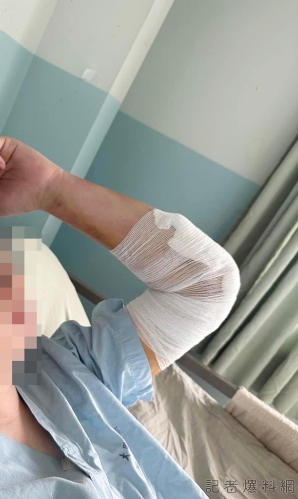 男大生車禍「手肘脫臼恐怖三聯症」 醫師助重建 89 S 17097043 | 健康 記者爆料網