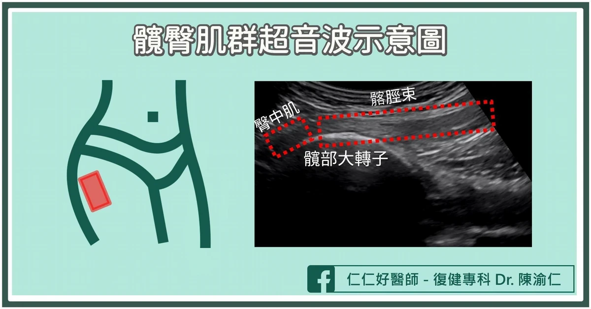 臀中肌受傷如何診斷?