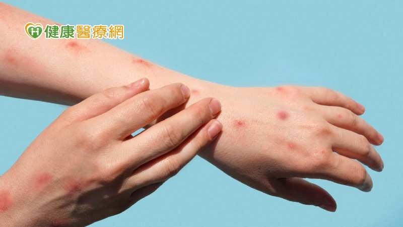 結節性癢疹「神經發炎」1顆癢全身! 研究曝治療新利器可有效改善