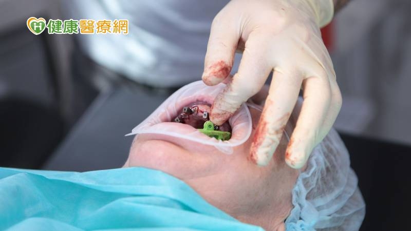人工牙根掉入鼻竇 口外內視鏡手術急救