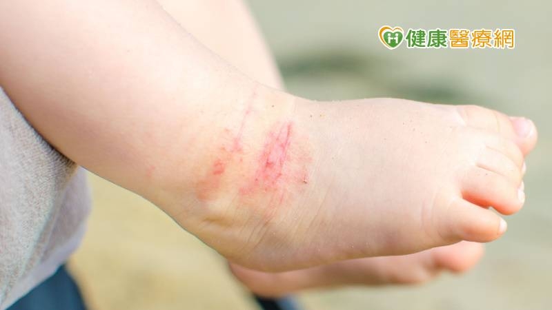 6個月大女嬰關節紅腫、又冒水泡 竟是「1皮膚病」惹禍