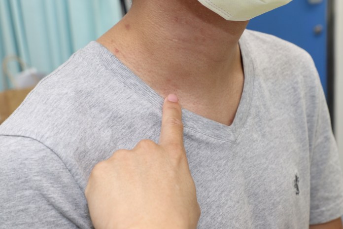 蟹足腫體質又見頸部有腫塊 微創手術切除不留疤 90 | 健康 記者爆料網