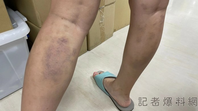 中年婦加班勞累體驗「撥筋」 腿部小血管破裂宛如瘀傷 84 3 22 scaled | 健康 記者爆料網