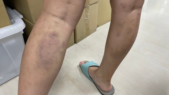 中年婦加班勞累體驗「撥筋」 腿部小血管破裂宛如瘀傷 81 3 22 | 健康 記者爆料網