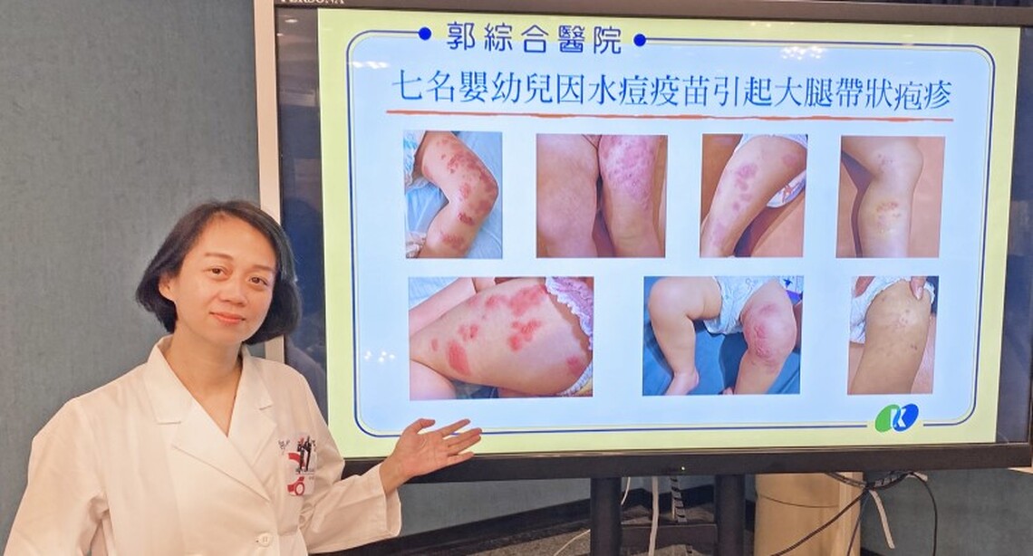 台南郭醫7嬰幼兒施打水痘疫苗罹帶狀泡疹幸無礙
