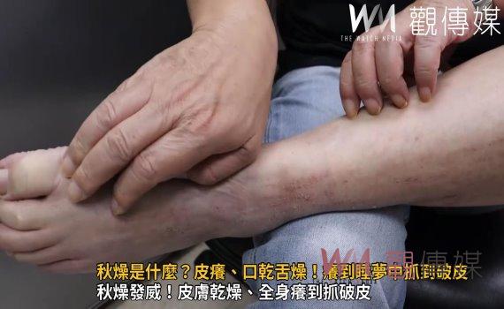 影/秋燥是什麼?皮癢、口乾舌燥!癢到睡夢中抓到破皮